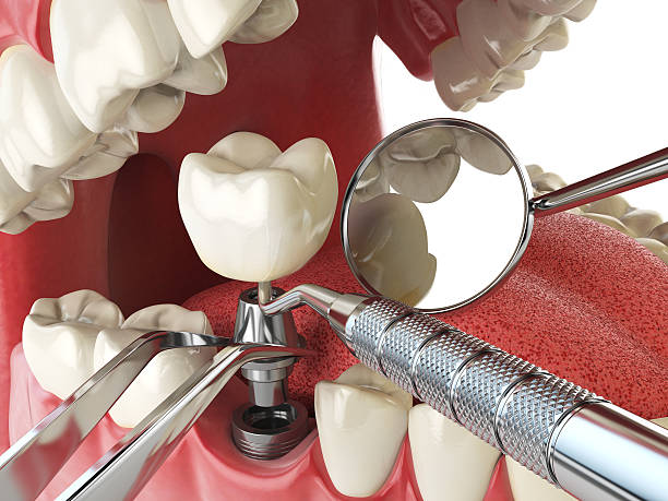 Best Emergency Wisdom Teeth Removal in Hebron, IL